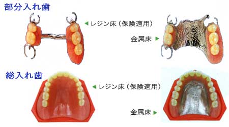 部分いればと総入れ歯